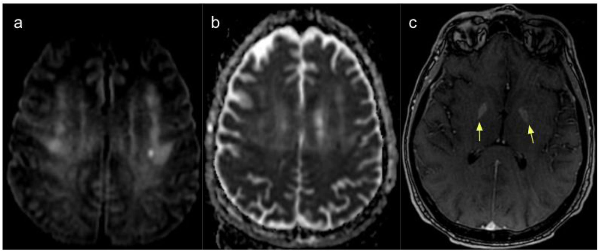Heat stroke with neurological involvement | Neurology perspectives