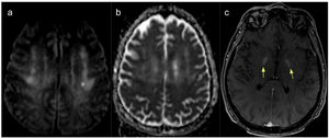 MRI scan showing alterations at the supratentorial level. (A) DWI. (B) ADC image showing diffusion restriction in the corona radiata, particularly on the left side. (C) T1-weighted sequence showing increased contrast uptake in the globi pallidi.