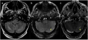 MRI scan of the cerebellum. (A) T2-weighted FLAIR sequence showing hyperintense lesions in the cerebellar hemispheres (dentate nuclei), predominantly on the right side, coinciding with areas of diffusion restriction on DWI sequences (image not displayed). (B) SWAN sequence showing a haemorrhagic focus in the left cerebellum. (C) Contrast T1-weighted sequence revealing foci of increased contrast uptake in the left cerebellum.