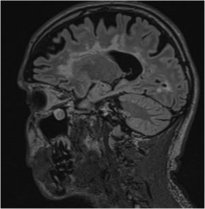Sagittal 3D FLAIR sequence. Multiple extensive white matter lesions.