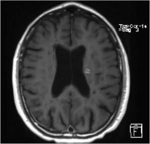 Gadolinium-enhanced FLAIR sequence. Axial slice showing a gadolinium-enhancing lesion.