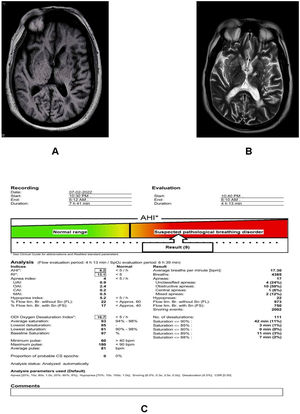 Axial-T1- (A) and T2-weighted (B) images reveal generalized cortical atrophy with bilateral periventricular white matter subacute ischemic changes, and old lacunar infarcts in bilateral basal ganglia, right thalamus as well as in periventricular white matter. Fig. C shows alterations in polysomnography parameters.
