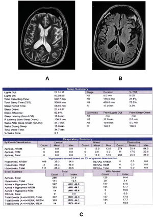 Axial T1-weighted (A) and FLAIR (B) images reveal bilateral mild focal hyperintense signals involving periventricular and supraventricular white matter regions. Fig. C shows alterations in polysomnography parameters.