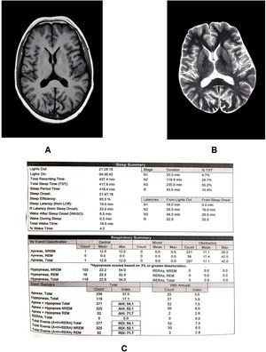 Axial-T1- (A) and T2-weighted (B) images reveal normal findings. Fig. C shows alterations in polysomnography parameters.