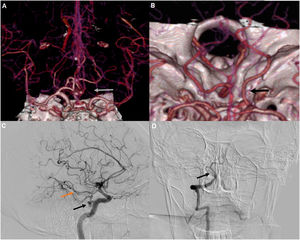 Anatomic variations in our sample, 3D-CTA (A) and (B) A. Absence of an A1 segment of the right anterior cerebral artery (white arrow). B. Right posterior fetal cerebral artery (black arrow). The P1 segment is absent. DSA image of the right internal carotid and right vertebral artery (C) and (D). C. Trigeminal persistent artery arising from the cavernous segment of the internal carotid (Black arrow), posterior communicating artery, (orange arrow). D. Hypoplasia of the basilar artery (black arrow).