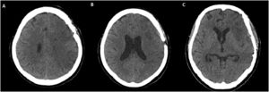 Hemispheric cerebral infarction in our sample, Axial CT scan (A), (B), and (C). Images show hypoattenuation of the total right MCA and ACA territory, with effacement of the adjacent sulci and loss of the gray-white matter distinction.