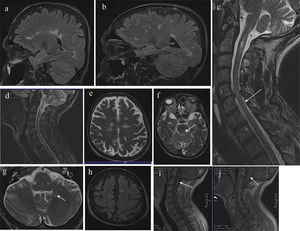 MRI study. (a) and (b) Sagittal FLAIR sequence; (c) sagittal T2-weighted sequence; (d) sagittal STIR sequence; (e–g) axial T2-weighted sequence; (h) axial FLAIR sequence; (i) and (j) gadolinium-enhanced T1-weighted sequence. Images show hyperintense lesions in the subcortical, juxtacortical, and periventricular white matter; and lesions in the corpus callosum and callososeptal interface, pontomesencephalic junction, pons (←), spinal bulb, and cerebellum (←). Mild cortico-subcortical atrophy is observed. Multiple spinal cord lesions of differing sizes are shown, affecting practically all levels, with a large lesion at the C2 level, mainly on the right side. The thoracic spine (←) displays lesions at T1–T2, T5–T6, T7–T8, T9–T10, and T11. Lesions in the bulbar region (←) and at C2 (←) present gadolinium uptake.