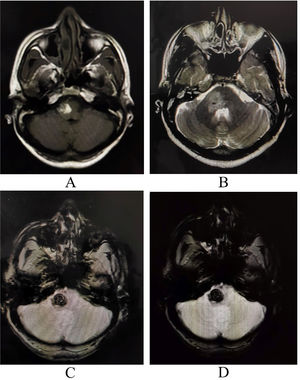Magnetic resonance imaging of the brain revealing altered intensity lesion hyper on T1- (A) and T2-weighted imaging (B) with signal blooming on GRE/SWI (C and D) sequences on the right side of pons with surrounding well-circumscribed edema extending up to upper medulla and right middle cerebellar peduncles and mild mass effect over the fourth ventricle, suggestive of cavernous cerebral malformation with recent hemorrhage within the lesion.