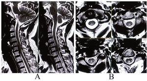 MRI of the cervical spine reveals longitudinally extensive signal changes, hyper on T2-weighted image (A, sagittal and B, axial) extending from the craniovertebral junction up to C4 level, distinctly involving the posterior column of the high-cervical cord.
