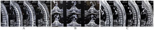 MRI of the dorsal spine reveals a focal cord thinning (A: sagittal T2-weighted image, B: axial T2-weighted image, C: sagittal T1-weighted image) at D3–D10 suggestive of focal dorsal cord atrophy.