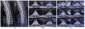 MRI of the dorsal spine reveals a longitudinally extensive hyperintense lesion on T2-weighted image (A, sagittal, and B and C, axial) extending from D4 to D10 suggestive of long segment myelopathy.
