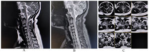 MRI of the cervical spine reveals a extensive hyperintense lesion on the T2-weighted image and T2-STIR (A and B, sagittal and C, axial) extending from C5 to D1 level with minimal focal cord swelling suggestive of long segment myelopathy.