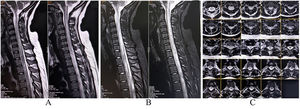 MRI of the cervical spine reveals a longitudinally extensive hyperintense lesion on the T2-weighted image and T2-STIR (A and B, sagittal, and C, axial) extending from the lower medulla to D5 level suggestive of cervical–dorsal myelopathy.