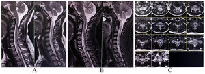 MRI of the cervical spine reveals a longitudinally extensive hyperintense lesion on T2-weighted and T2-STIR (A and B, sagittal, and C, axial) images extending from C4 to D1 level suggestive of non-compressive myelopathy.