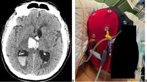 (A) Haematoma located in the right basal ganglia, with intraventricular extension. (B) EEG electrode cap used in our patient with an external ventricular drain.
