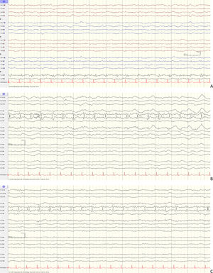 EEG recording. (A and B) Longitudinal and transverse bipolar montage EEG. Periodic discharges detected only by the Fz electrode, which occur 120 ms after the QRS complex of the ECG channel, rather than synchronously. C) Transverse bipolar montage EEG recording after administration of midazolam. Suppression of background activity, without changes in the abnormal activity shown in the other figures.