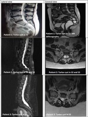 Series of 5 patients with Tarlov cysts confirmed by MRI (lateral and coronal views). MRI of the sacrum revealed perineural cysts at the level of the S1, S2, or S3 nerve roots, which were hypointense on T1-weighted sequences and hyperintense on T2-weighted sequences (consensus among radiologists).