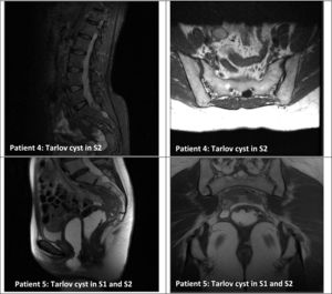 Series of 5 patients with Tarlov cysts confirmed by MRI (lateral and coronal views). MRI of the sacrum revealed perineural cysts at the level of the S1, S2, or S3 nerve roots, which were hypointense on T1-weighted sequences and hyperintense on T2-weighted sequences (consensus among radiologists).