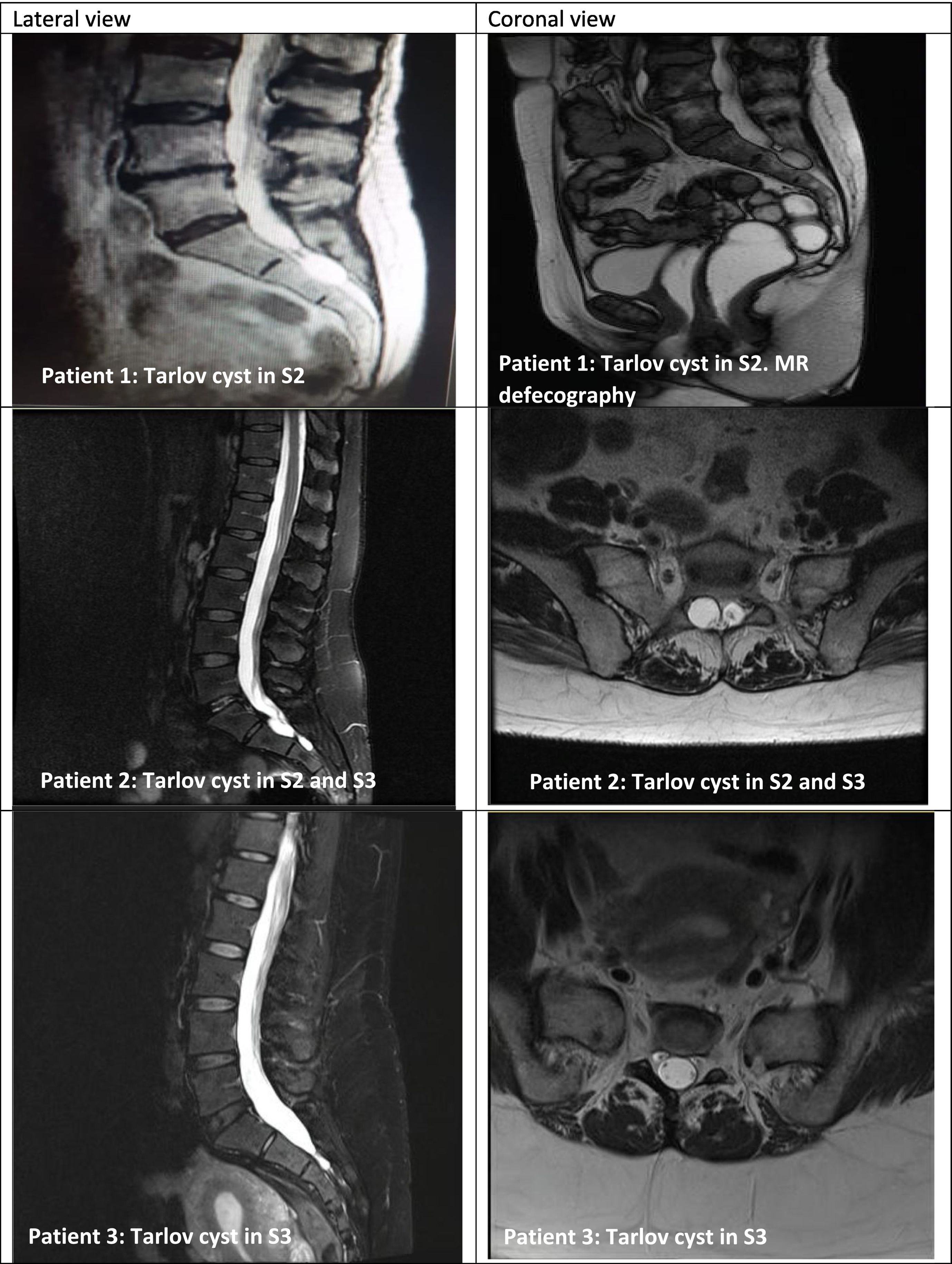 Symptomatic Tarlov cysts: A case series and effectiveness of multimodal ...
