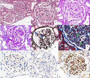 (A–C) Haematoxylin-eosin staining, 20× (A) and 40× (B–C). The images display overall and diffuse thickening of the glomerular basement membrane (GBM), and focal and diffuse mesangial expansion. (D) Periodic acid–Schiff (PAS) stain, 40×. We identified mesangial expansion positive for PAS staining and GBM thickening. (E) Histochemical study with methenamine silver stain (Jones staining), 40×. This image shows the thickening of the GBM and the presence of focal spicules (blue arrow). (F) Masson's trichrome stain, 40×. This image shows the presence of subepithelial fucsinophilic deposits (green arrows). (G) PLA2R immunohistochemical staining, 40×. Absence of positivity. (H) IgG4 staining, 40×. Absence of positivity. (I) C4d staining, 40×. The image shows presence of overall and diffuse linear positivity at the GBM, as compared to C4d staining. (For interpretation of the references to colour in this figure legend, the reader is referred to the web version of this article.)