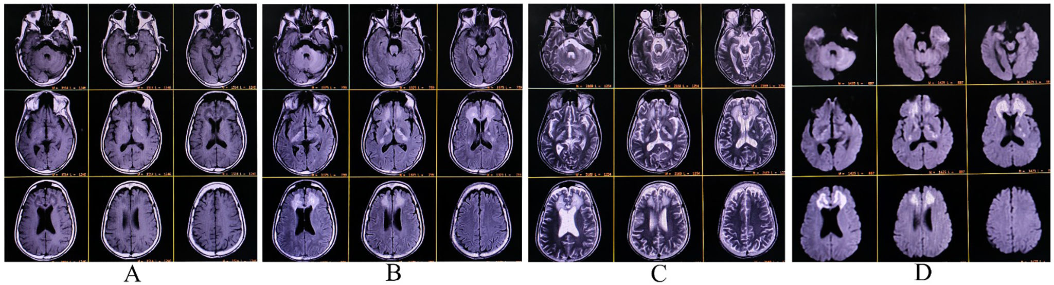 Adult-onset cerebral X-linked adrenoleukodystrophy presenting with ...