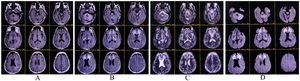 Magnetic resonance imaging of the brain reveals bilaterally symmetrical hyperintensity lesions on T1-weighted (A), T2-weighted-fluid-attenuated inversion recovery (B), T2-weighted images (C) with areas of strongly restricted diffusion on diffusion-weighted image, which was confirmed on the apparent diffusion coefficient map (not shown) (D) involving sub frontal periventricular white matter, the corticospinal tracts and cerebellar white matter, and atrophy of midbrain, pons, and medulla suggestive of adult-onset leukodystrophy.