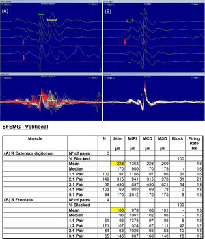 Single-fiber electromyography (SFEMG). Volitional (voluntary) SFEMG recorded by concentric needle electrodes in the right (R) extensor digitorum (ED) (A) and frontalis (FR) (B) muscles found remarkably increased mean jitter (ED: 228 μs [upper limit 30 μs],13 FR: 100 μs [upper limit 28 μs],13 highlighted in yellow) with 100% impulse blocking in both muscles, showing a severe impairment of the postsynaptic neuromuscular junction of generalized distribution, suggestive of generalized myasthenia gravis. The jitter value was calculated by the mean consecutive difference (MCD) for each pair. We were able to study only five pairs in the R ED and four in the R FR due to the patient