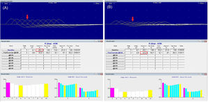 Repetitive nerve stimulation. Low-frequency repetitive nerve stimulation (RNS) at 3 Hz of the right (R) ulnar nerve recording from abductor digiti minimi revealed 20.1% (red box) decrement in amplitude from the first to the fourth compound muscle action potential (CMAP) (red arrow), corresponding to clinical muscle fatigability (A). And a maximal 43.2% (red box) decrement 2 min after exercise lasting 1 min (red arrow) (B). These results are suggestive of postsynaptic neuromuscular junction disorder. (For interpretation of the references to color in this figure legend, the reader is referred to the web version of this article.)