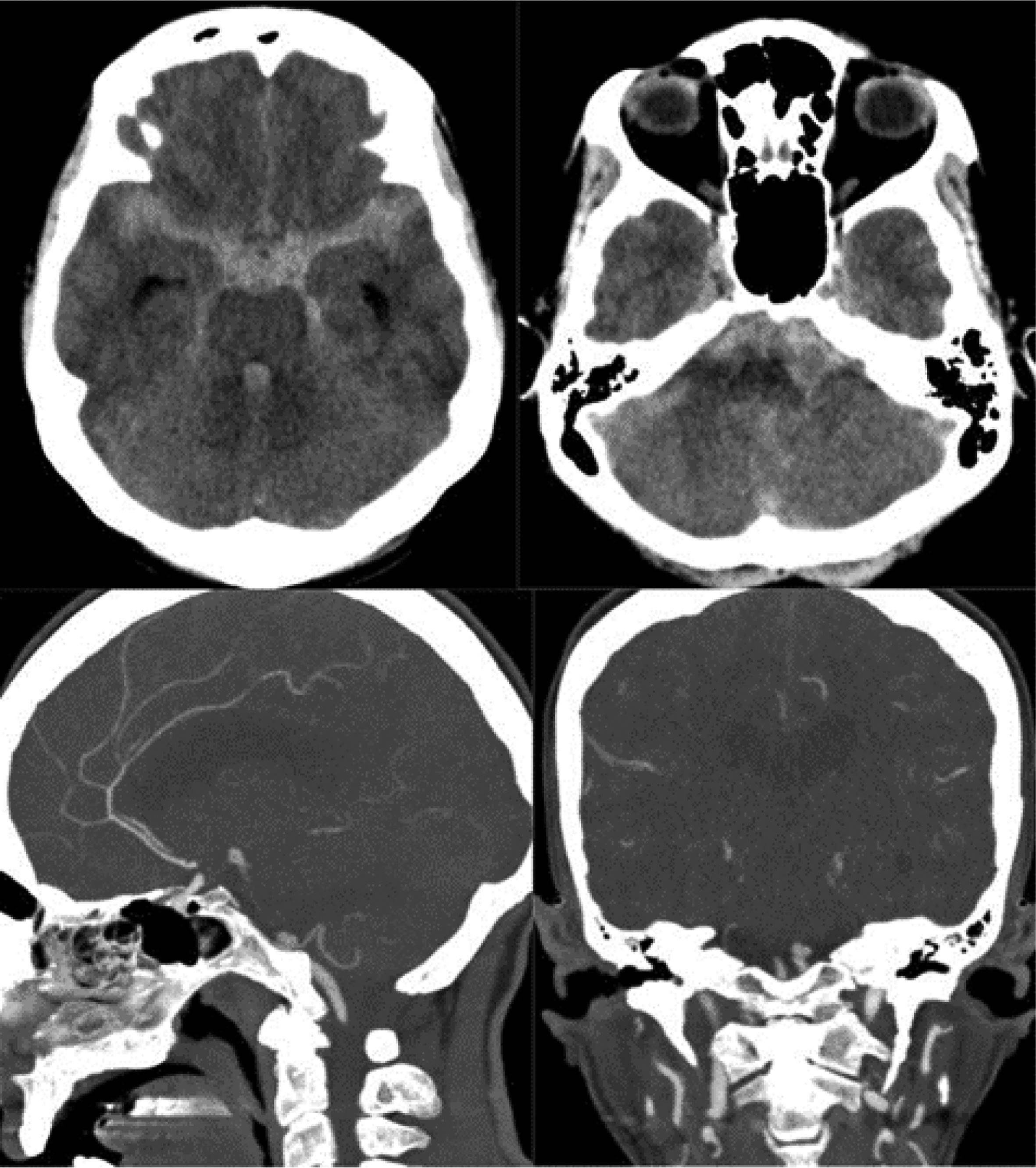 Update on diagnosis and treatment of aneurysmal subarachnoid hemorrhage ...