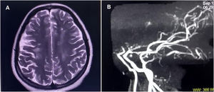 (A) Brain magnetic resonance imaging shows multiple hyperintense lesions on T2-weighted sequences in the left frontoparietal, paraventricular, and anterior centrum semiovale regions, consistent with subacute non-hemorrhagic infarcts. Additional non-enhancing discrete and confluent hyperintense lesions in the right periventricular white matter and centrum semiovale on T2-weighted and FLAIR images are suggestive of chronic angiopathic changes. (B) Magnetic resonance angiography (sagittal view) shows an abrupt cut-off of flow at the supraclinoid segment of both internal carotid arteries, just proximal to the bifurcation into anterior and middle cerebral arteries. The left internal carotid artery appears narrower than the right. The posterior circulation (vertebral, basilar, and distal branches) remains intact, supplying the anterior circulation, a finding characteristic of Moyamoya angiopathy.