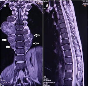 (A) Coronal T2-weighted thoracic magnetic resonance imaging reveals bilateral paravertebral masses consistent with extramedullary hematopoiesis. (B) Sagittal T2-weighted spinal magnetic resonance imaging shows no signs of spinal cord compression.