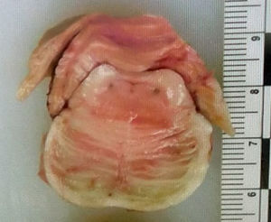 Macroscopic image of the pons. The bilateral dorsal region displays 2 punctiform areas; these correspond to the locus coeruleus and are visible due to the structures’ neuromelanin content.