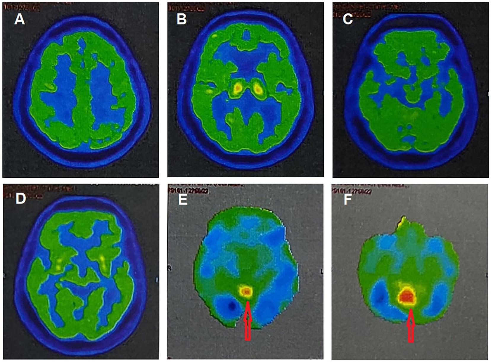 Bálint syndrome in dementia with lewy bodies: A new phenotypic variant ...