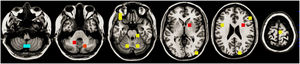 Gray and white matter increases (red), gray matter decreases (cyan), and white matter decreases (yellow), associated with an increased risk of relapse after a manic episode (classical survival analysis). Axial slices at (MNI) Z=−48, −36, −24, 0, 24, and 72.