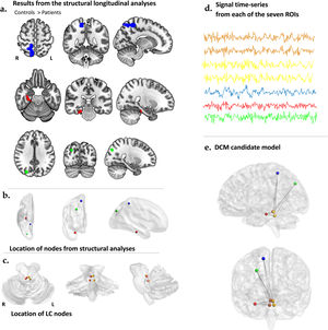 Effective connectivity analysis pipeline. (a) Regions that exhibited significant between-group differences in volume, where controls had greater values than patients, as revealed in the longitudinal structural data analyses. (b) These nodes, serving as the ROIs (region of interest) or seeds of interest, were selected from the peak coordinates of the structural analyses described in ‘a.’ These nodes include the posterior hippocampus (PHC), in red, the posterior cingulate cortex (PCUN), in light green, and the ventral anterior cingulate (VAC), in blue, all from the right hemisphere. (c) The LC ROIs were selected from two different divisions of each hemisphere nuclei: the right rostral and caudal divisions are depicted in orange, while the left rostral and caudal divisions are depicted in yellow. (d) Time series data extracted from each of the ROIs mentioned in ‘b.’ and ‘c.’ were utilized to perform spectral dynamic causal modeling. (e) In our model, we assumed intrinsic connectivity between the different divisions of the LC and the brain regions that exhibited differential volume decreases between patients and controls over time.