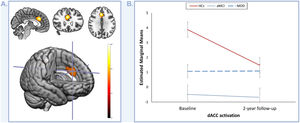 Longitudinal group differences in the dorsal anterior cingulate cortex (dACC) activations. (A) Depicts the identified longitudinal decrease in dACC activation in subjects with amnestic type mild cognitive impairment (aMCI) compared to healthy controls (HCs) during the oddball stimuli>standard stimuli contrast. The color bar represents t-values. (B) Depicts the evolution of dACC activation in healthy controls (HCs), subjects with amnestic type mild cognitive impairment (aMCI), and patients with late-life major depressive disorder (MDD) over the two-year follow-up period.