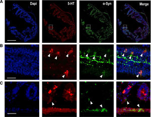 (A) Representative confocal images showing α-Syn protein (green; Ref: ab212184, 1:250) co-localized with 5-HT-positive cells (red; Ref: Immunostar 20079, 1:1000) in mouse duodenum. Scale bar: 1mm. (B) Higher magnification confocal images identified in (A) with inset, showing 5-HT-positive mouse intestinal epithelium cells containing α-Syn protein. Scale bar: 250μm. (C) Representative confocal images showing α-Syn-positive fibers close to 5-HT-positive epithelium cells in the mouse duodenum. The ascending pathology hypothesis of α-Syn proposes that uptake of the toxin by epithelium cells in contact with nerves and glia in the GI tract, may cause aggregation of α-Syn within these cells and this aggregated protein may migrate to enteric nerves, thus initiating a pathogenic cascade leading to α-synucleinopathies.106 Scale bar: 20μm.