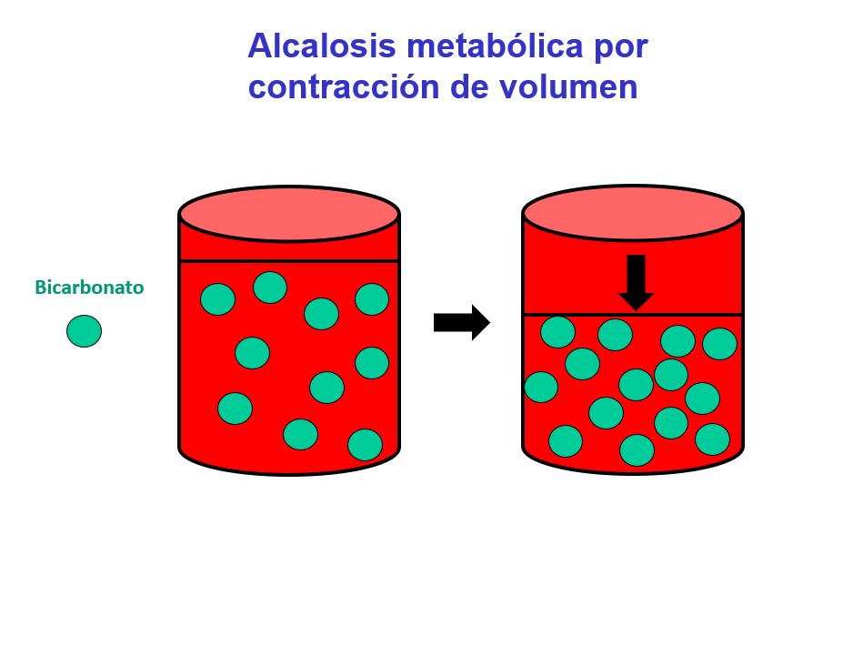 En la figura se muestra el mecanismo por el que la contracción de volumen produce alcalosis metabólica.