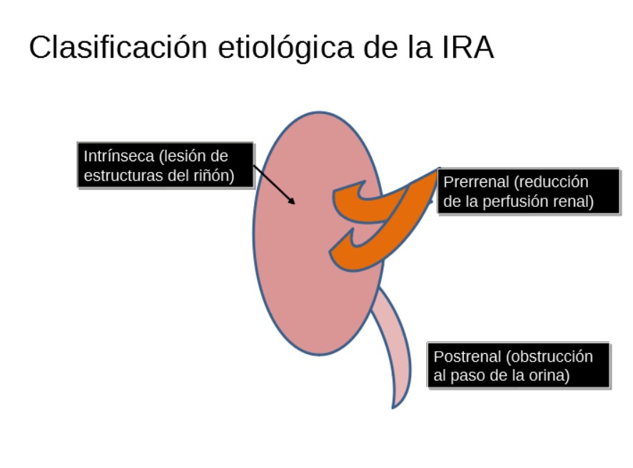 De forma clásica se ha dividido en causas pre renales producidas por una reducción de la perfusión renal causas postrenales por obstrucción de la vida ordinaria y causas intrínsecas o parenquimatosas producidas por lesión estructural del riñón. 