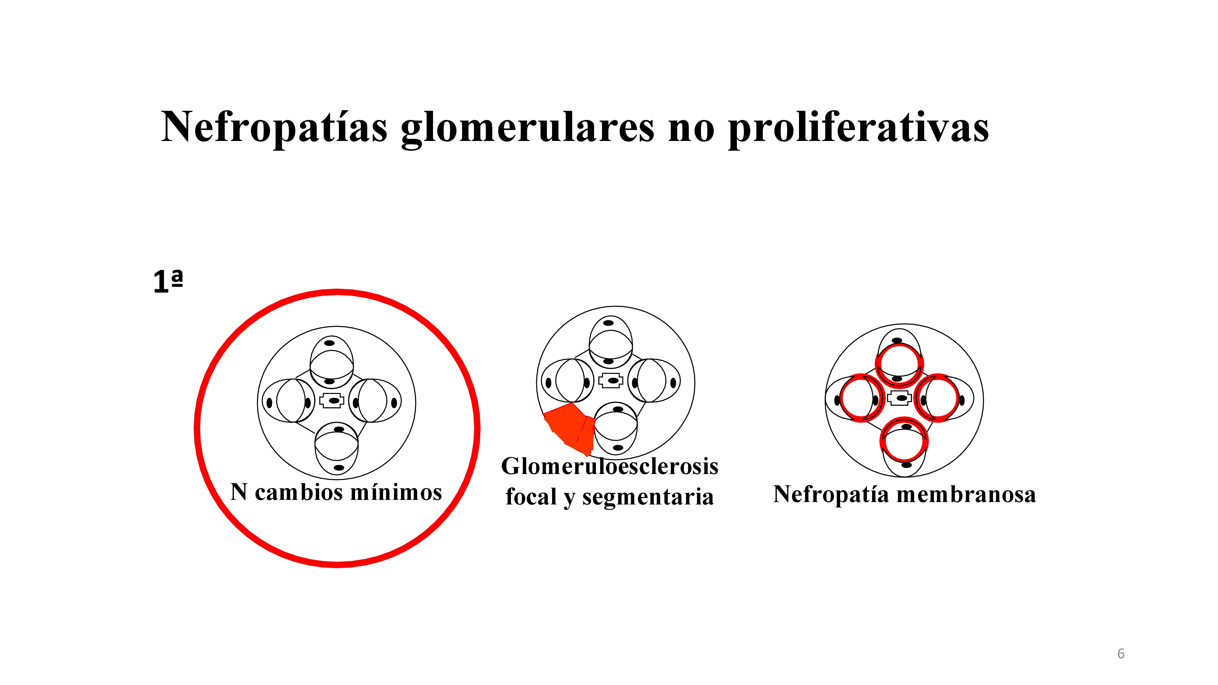 Dentro de las Glomerulonefritis primarias no proliferativas se encuentran la GMN de cambios mínimos, GMN focal y segmentaria y GMN membranosa. La primera que veremos será la GMN de Cambios mínimos.