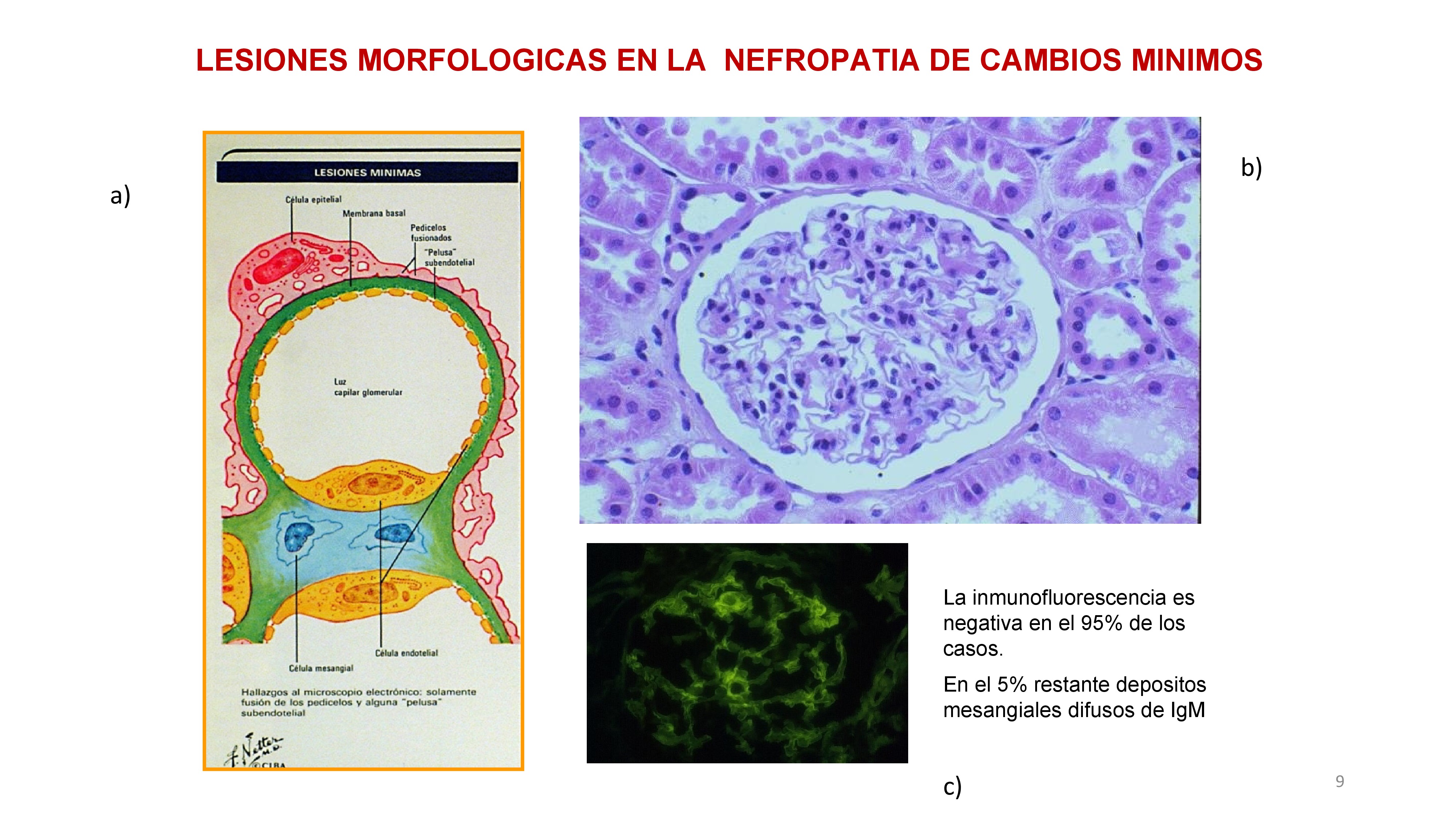 En la biopsia: a) En el dibujo se observa una fusión de pedicelos. B) MO con glomérulo normal. C) Inmunofluorescencia negativa, con un 5% de depósito de IgM.