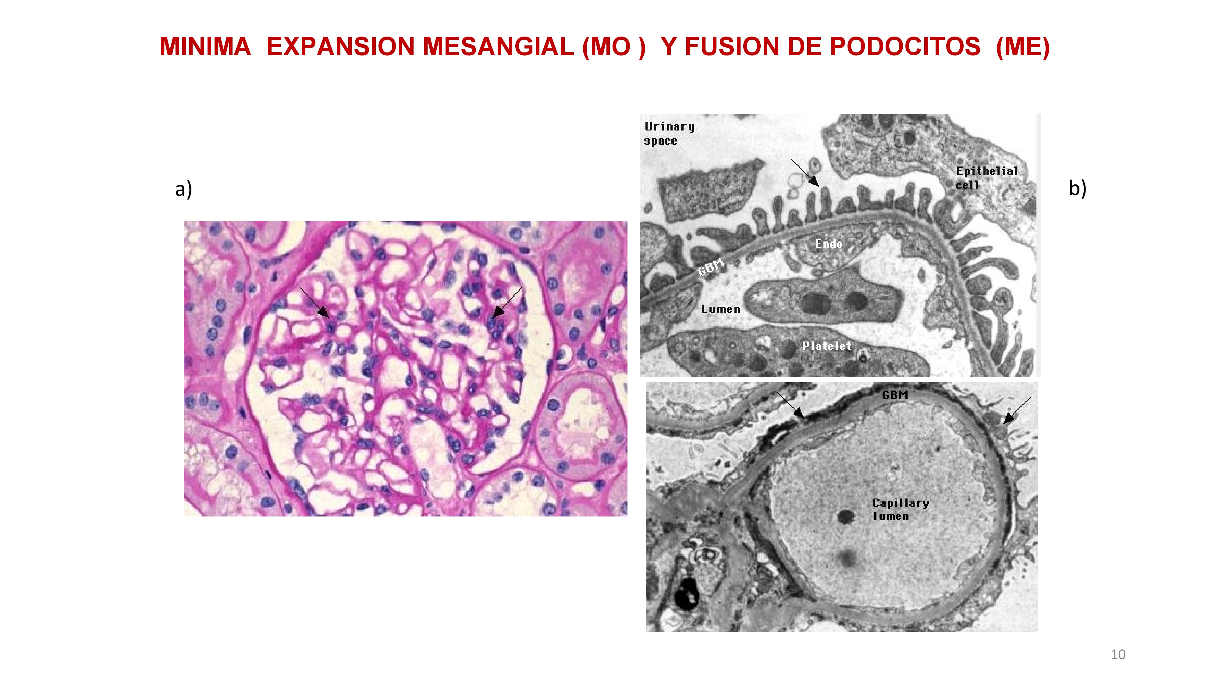En estas biopsias de GMN de cambios mínimos. A) una muy leve expansión mesangial. Se observa en las flechas material fusinófilo y células. B) En la parte superior un ME normal, y abajo fusión de pedicelos.