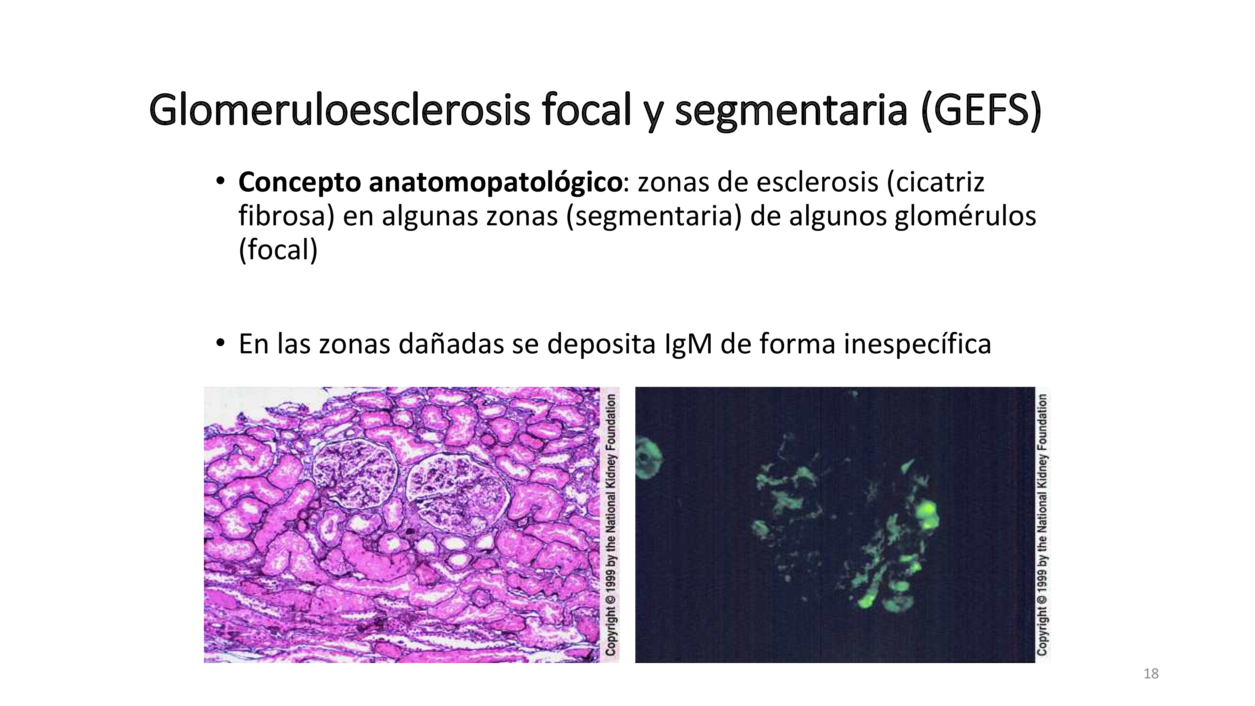 La anatomía patológica de la GMN focal y segmentaria se caracteriza por zonas de fibrosis en parte de algunos glomérulos muy característica. En esas zonas se deposita IgM que se ve en la inmunoflurescencia.