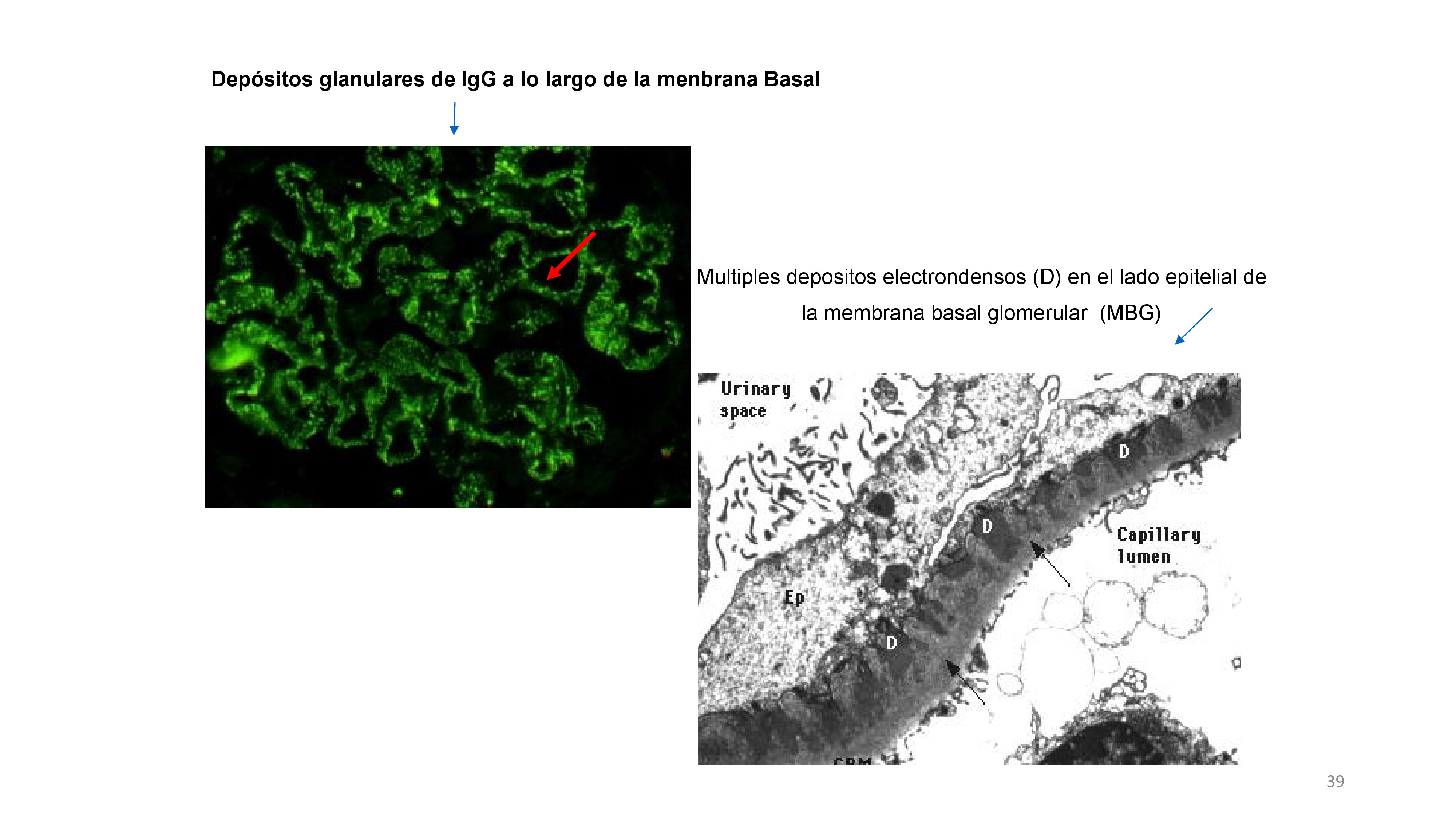 En la inmunofluorescencia se ven los ICC de IgG a lo largo de la membrana basal. En el microscopio electrónico se ven esos depósitos de ICC de IgG de color negro en la zona subepitelial. La membrana basal abraza los depósitos englobándolos e incrementando el grosor de la MB. 