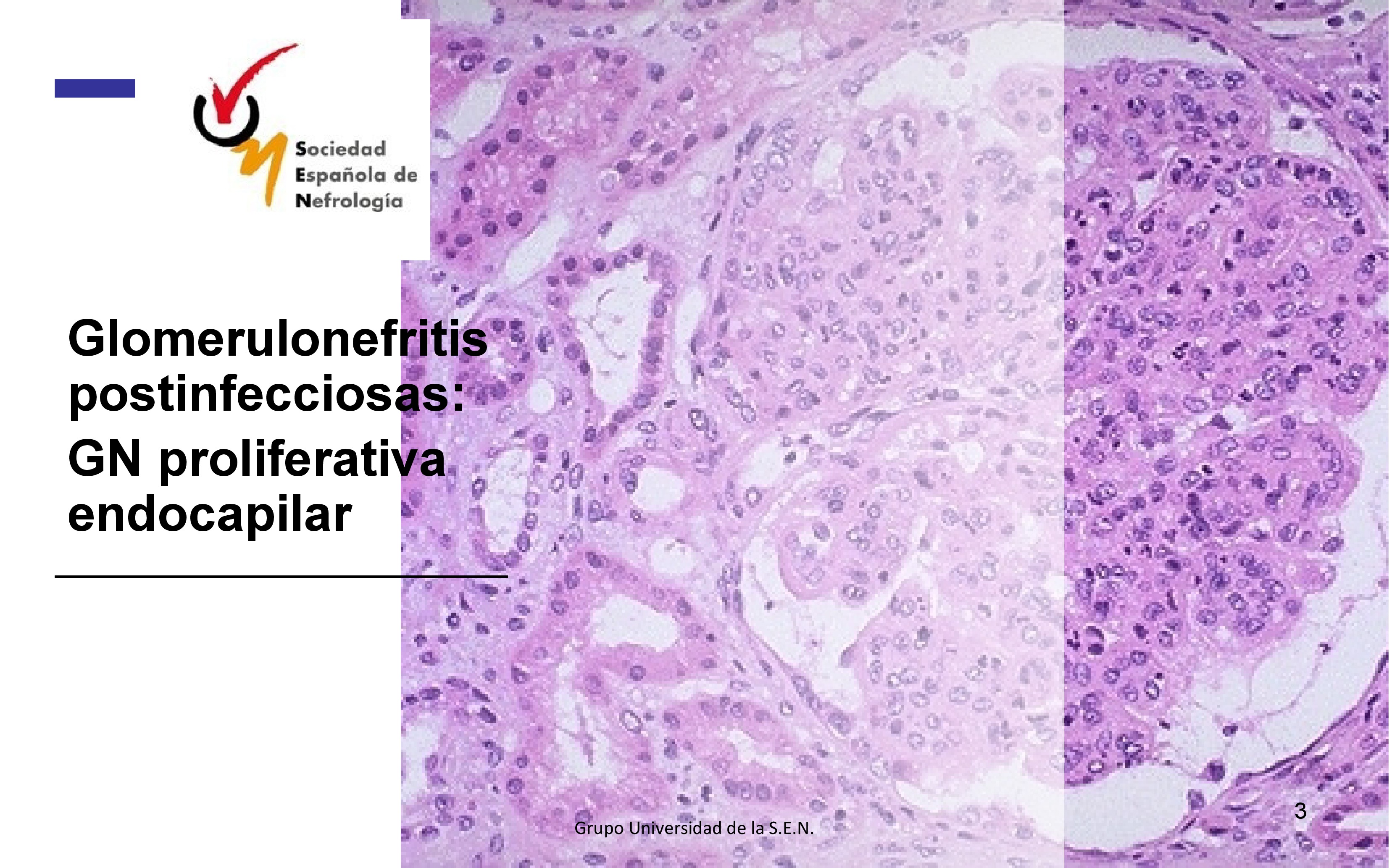 La glomerulonefritis postinfecciosa o glomerulonefritis proliferativa endocapilar como su nombre indica ocurre tras una infección