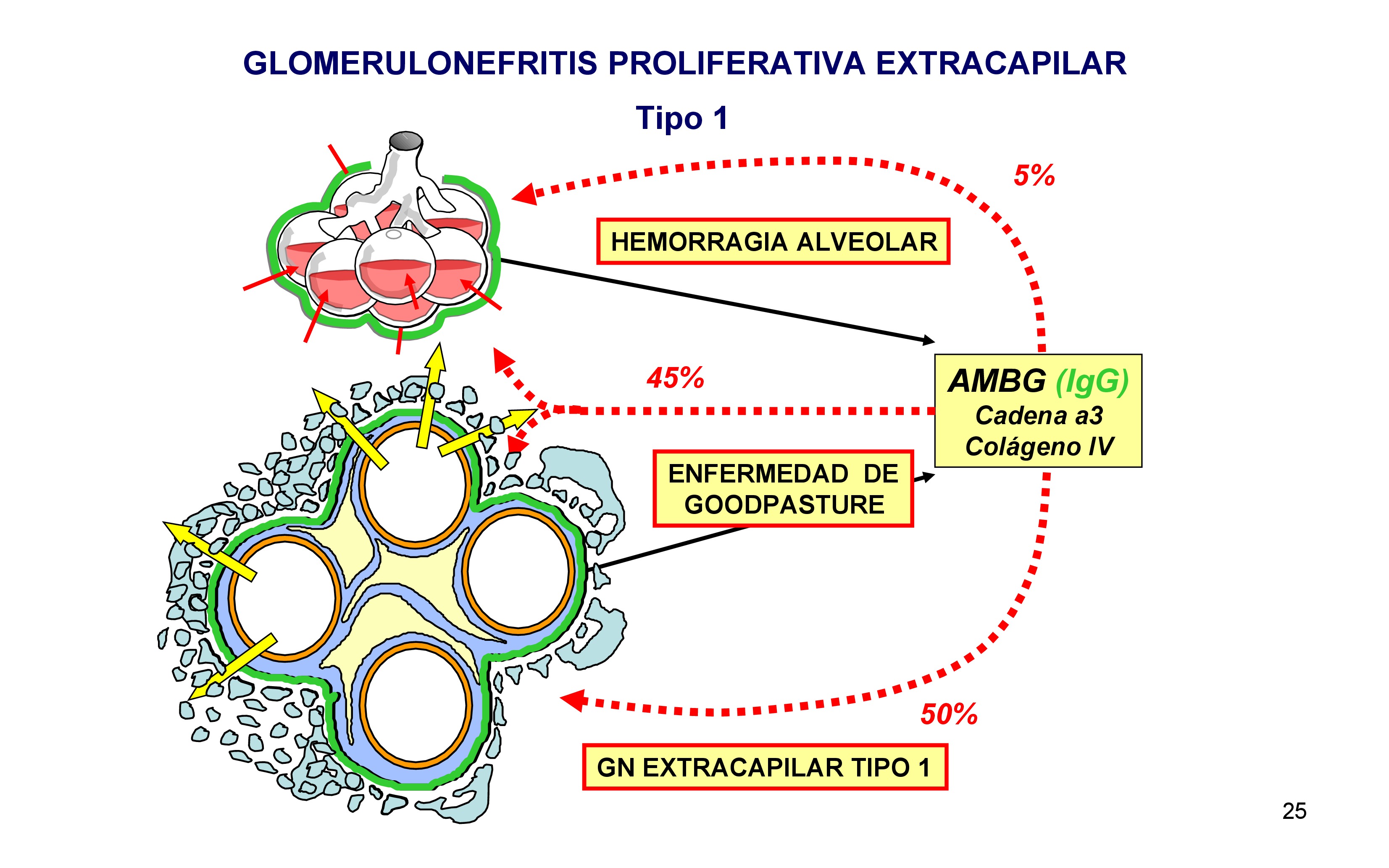La glomerulonefritis proliferativa extracapilar se produce por anticuerpos antimembrana basal glomerular. La membrana basal glomerular tiene en su composición cadena alfa-3 de colágeno tipo IV. Algunas personas desarrollan anticuerpos frente a esta cadena de colageno y se depositan en esta membrana, estos anticuerpos son IgG.
Cuando se depositan pueden romper la membrana basal glomerular, sale el plasma de las asas capilares y se produce una proliferación de células epiteliales en el espacio extracapilar formando las típicas semilunas. 
La membrana que rodea los sacos alveolares tiene la misma composición que la membrana basal glomerular, por lo que estos anticuerpos se pueden tambier depositar en esta membrana, rompiéndola y entrando sangre al saco alveolar produciendo una hemorragia alveolar.
En el 50% los anticuerpos solo se depositan en el glomérulo, en el 5% solo en pulmón y en el 45% en riñón y pulmón dando lugar a la enfermedad de Goodpasture. 