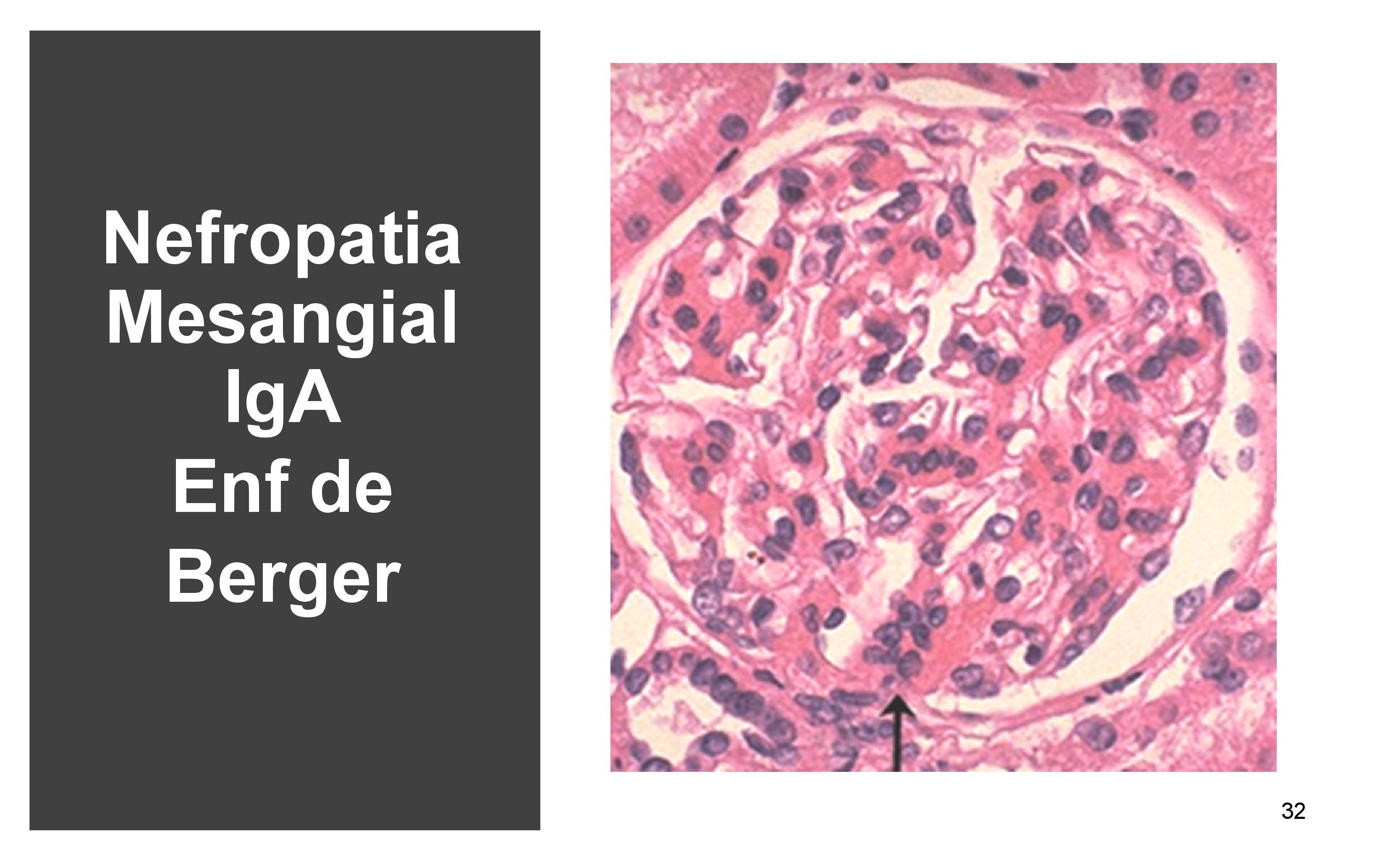 La nefropatía proliferativa mesangial es la mas frecuente , también se llama enfermedad de Berger porque la describió el Dr Berger del Hospital de Necker en Paris.
Es una glomerulonefritis con proliferación mesangial, en la biopsia observamos mas de 3 células por área de mesangia como vemos en la flecha.
