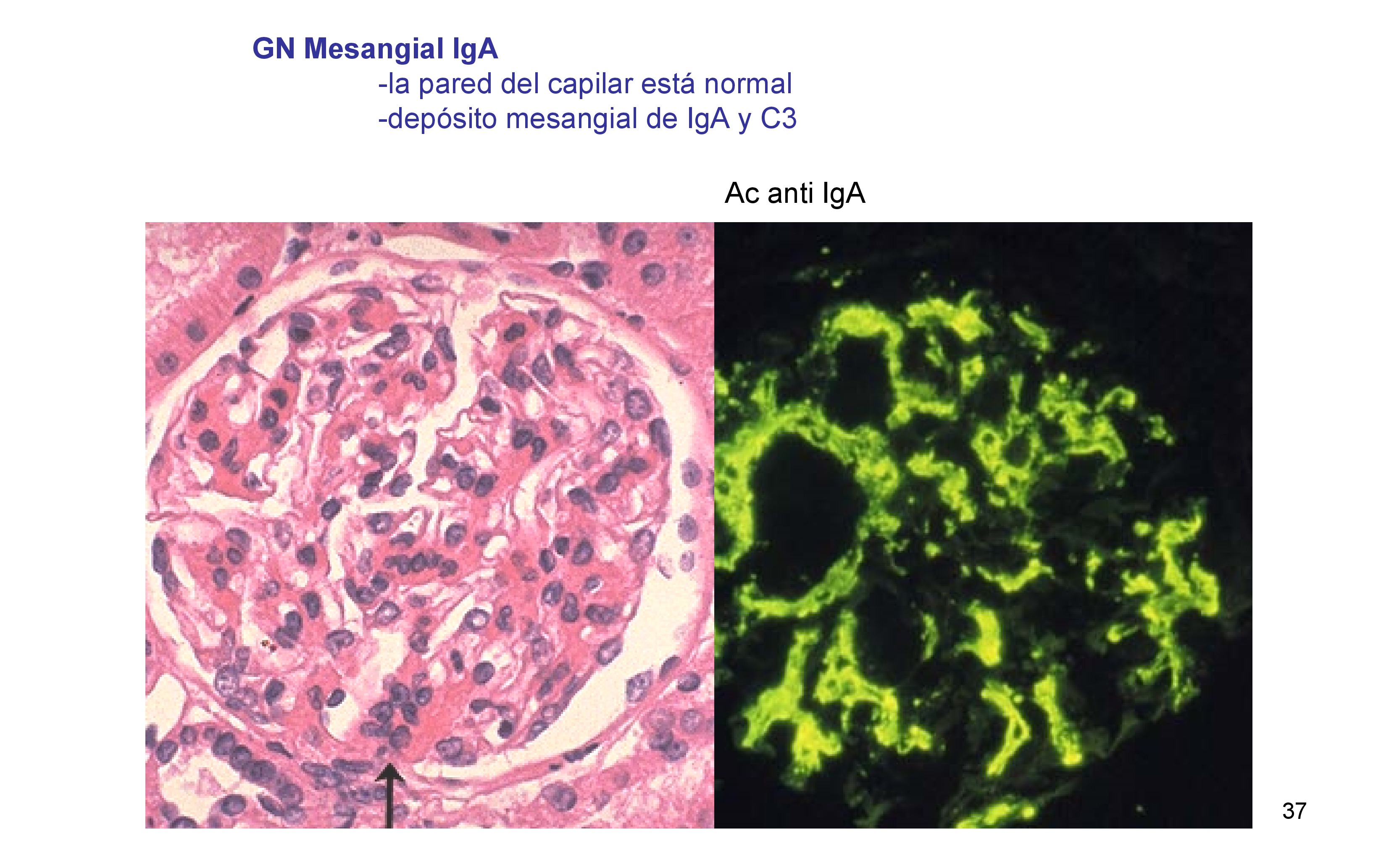 Biopsia típica de una glomerulonefritis mesangial IgA , la pared de los capilares esta normal, hay proliferación mesangial : 

Mas de tres células por área mesangial y depósitos de IgA y C3 en la inmunofluorescencia. 
