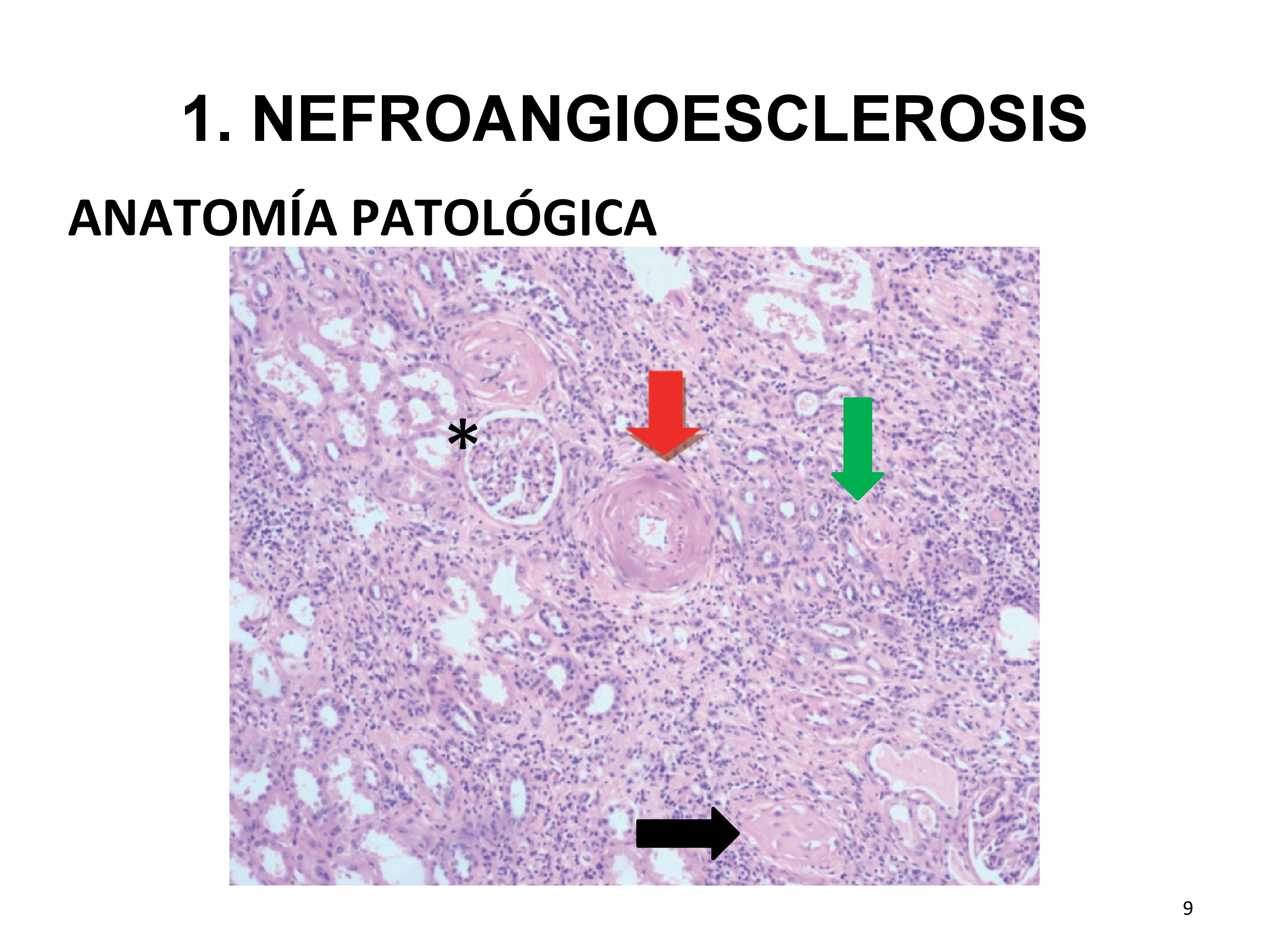 En los casos en los que se hace biopsia, la histología muestra datos inespecíficos de isquemia renal mantenida, que pueden aparecer en otras nefropatías. Entre los hallazgos, hay que destacar la presencia de esclerosis glomerular (flecha negra, compárese con un glomérulo normal marcado con asterisco), atrofia tubulointersticial (flecha verde) e hipertrofia de las paredes vasculares (flecha roja).