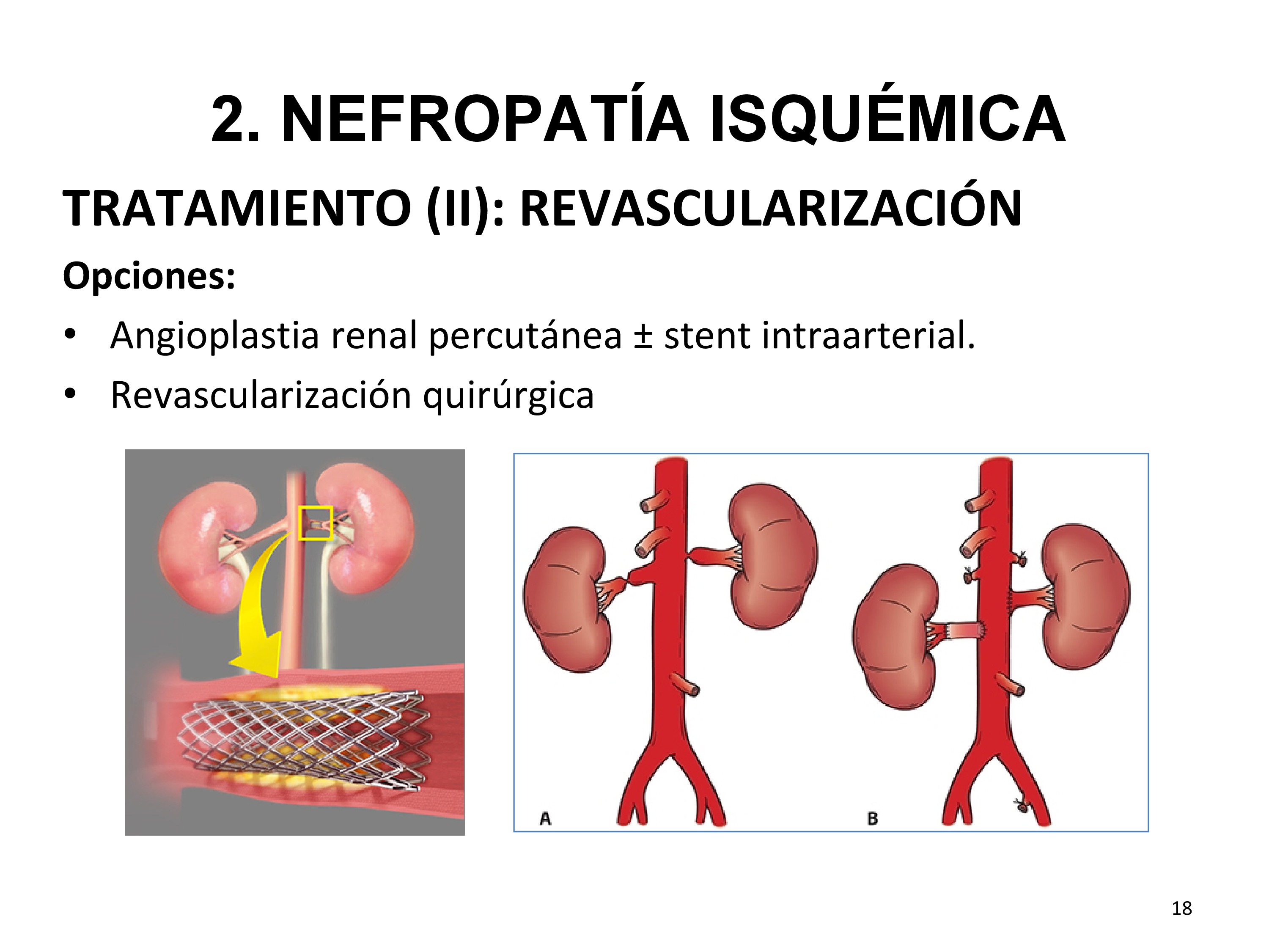 Las opciones de tratamiento revascularizador son:

Angioplastia renal percutánea, generalmente con colocación de stent (más usado, mejor resultado que sin stent).
Revascularización quirúrgica (bypass de la arteria renal desde la aorta o bypass hepatorrenal o esplenorrenal que evita una aorta enferma . Se usa principalmente para la corrección de lesiones vasculares complejas y /o episodios repetidos de reestenosis intra-stent).
